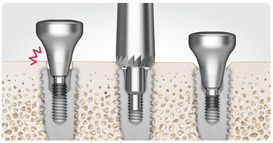 Bone Profiler