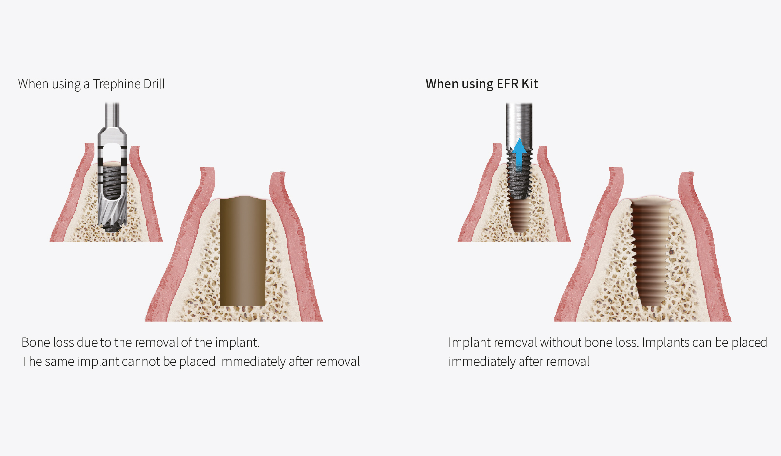 Implant removal with minimal bone loss