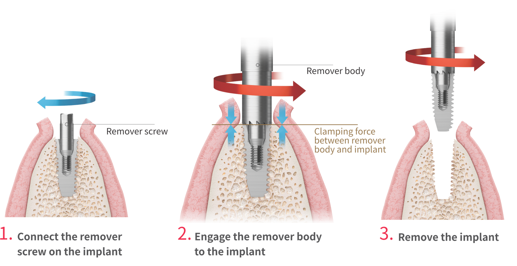 Remove failing or misplaced implants in only 3 steps