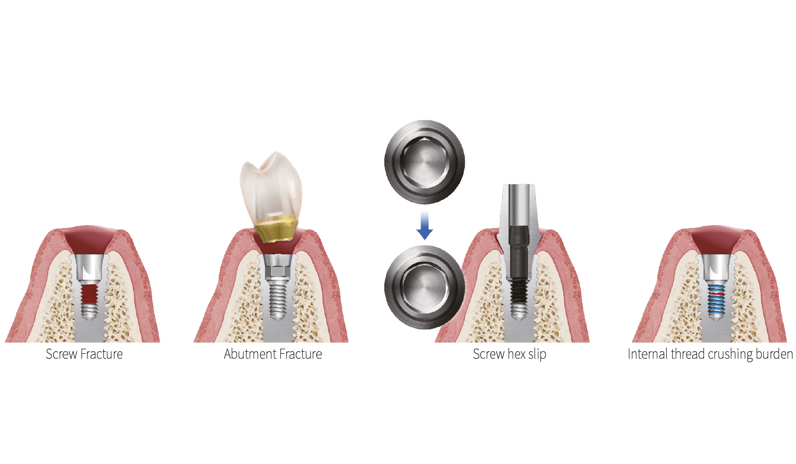 Compatible with various prosthetic failure cases