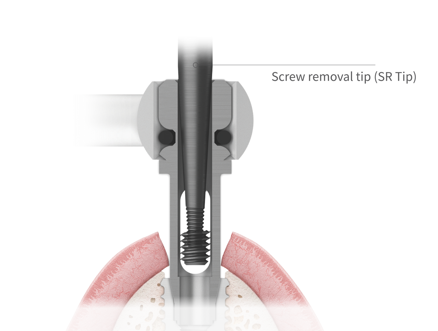 Removing a fractured screw
