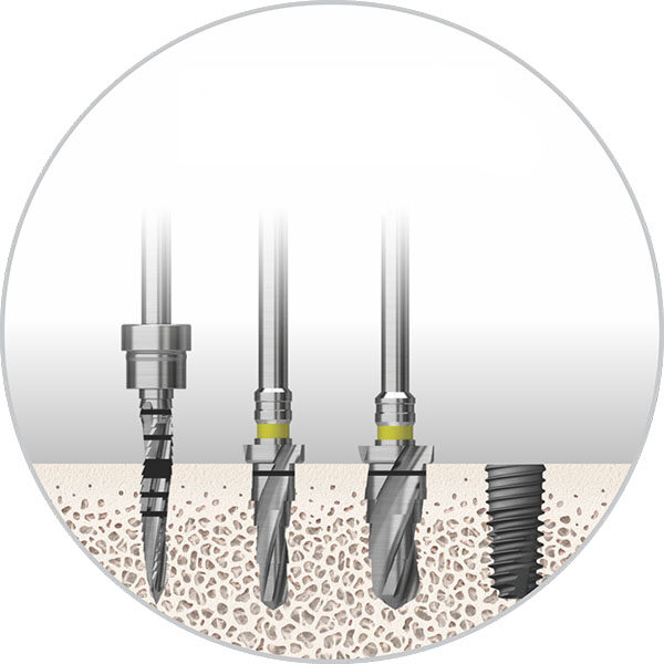 Hard bone implants can be completed in 2 Steps