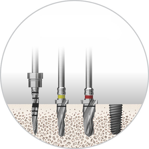 Normal bone implants can be completed in 2 steps