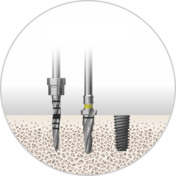 Soft bone implants can be completed in 1 step