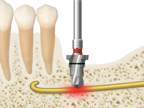 Conventional drill contacts inferior alveolar nerve
