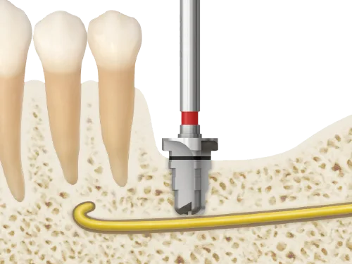 485 drill does not contact inferior alveolar nerve