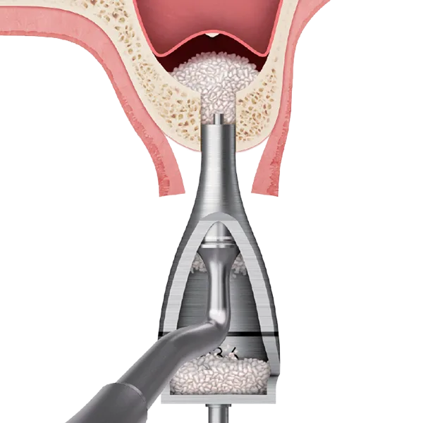 Safer bone grafting