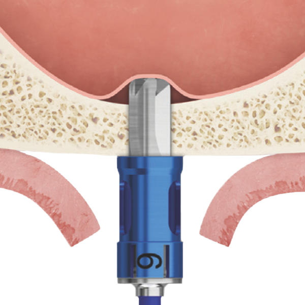 Flat Sinus Floor