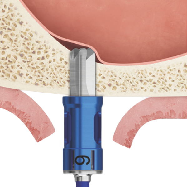 Inclined Sinus Floor