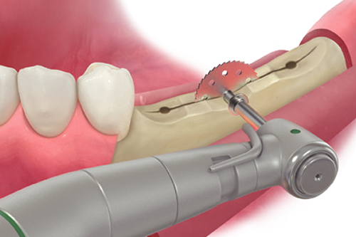 ESSET Kit — Ridge Split using saw