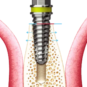 ESSET Kit Expansion Drill