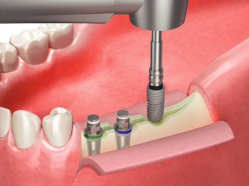 Safer and predictable expansion of the narrow ridge