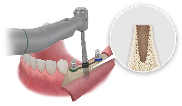 Place implants without excess torque