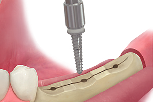 Step 4: Expansion drill