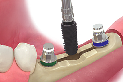 Step 5: Implant placement