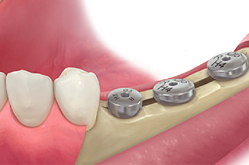 Step 7: Healing abutment