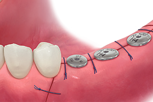Step 8: Suture