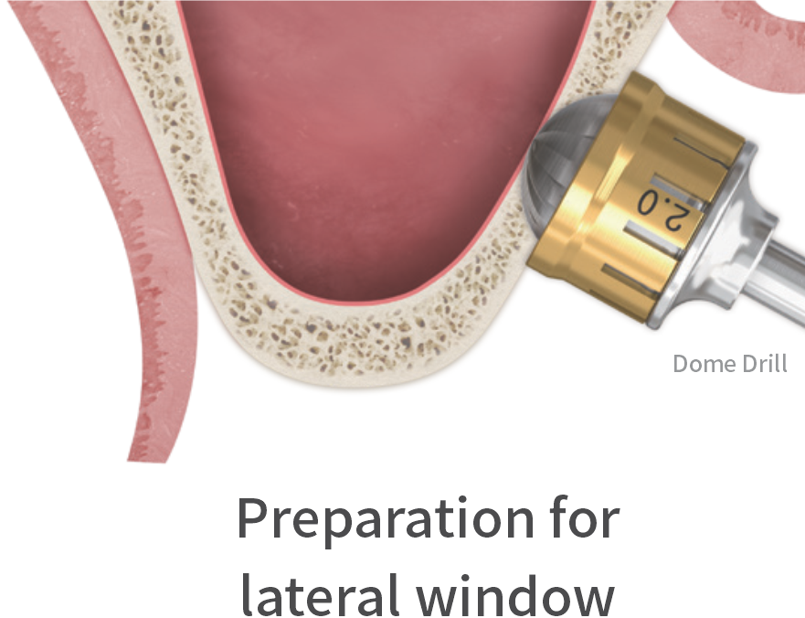 Minimizes the risk of membrane perforation