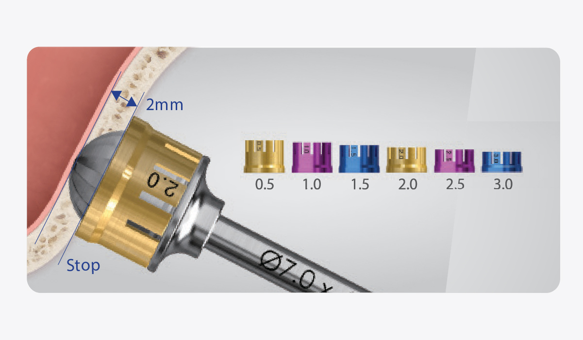 Provides simplicity to control residual bone depth