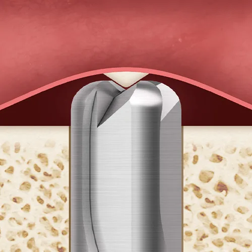 CAS Drill: Safe inverse conical drill and round cutting edge