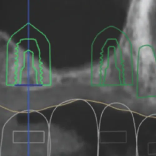 Implant placement planning