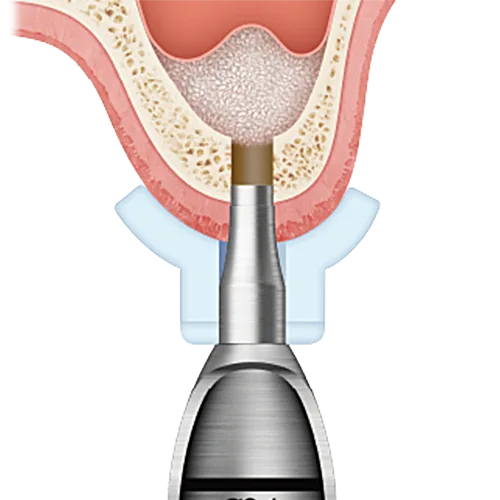 Step 3: Bone Grafting