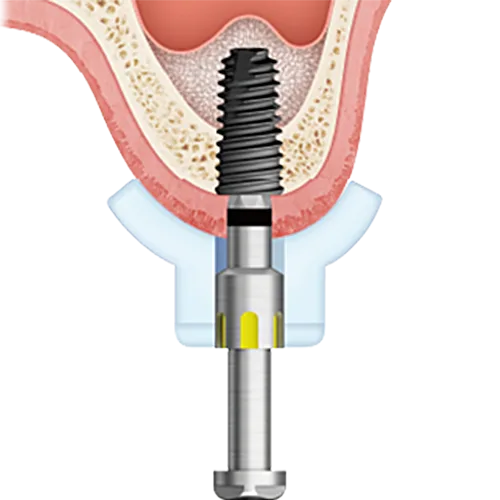 Step 4: Implant Placement