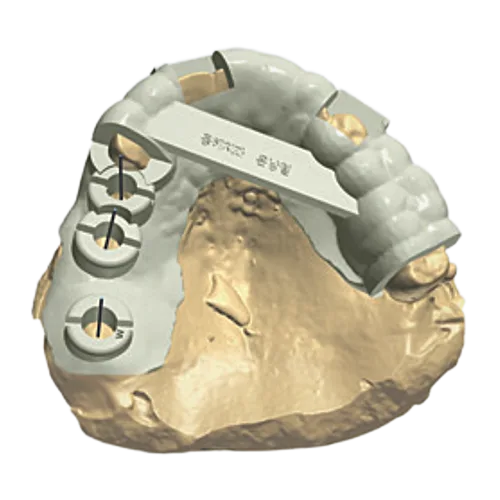 Fabricate surgical template for drilling accuracy