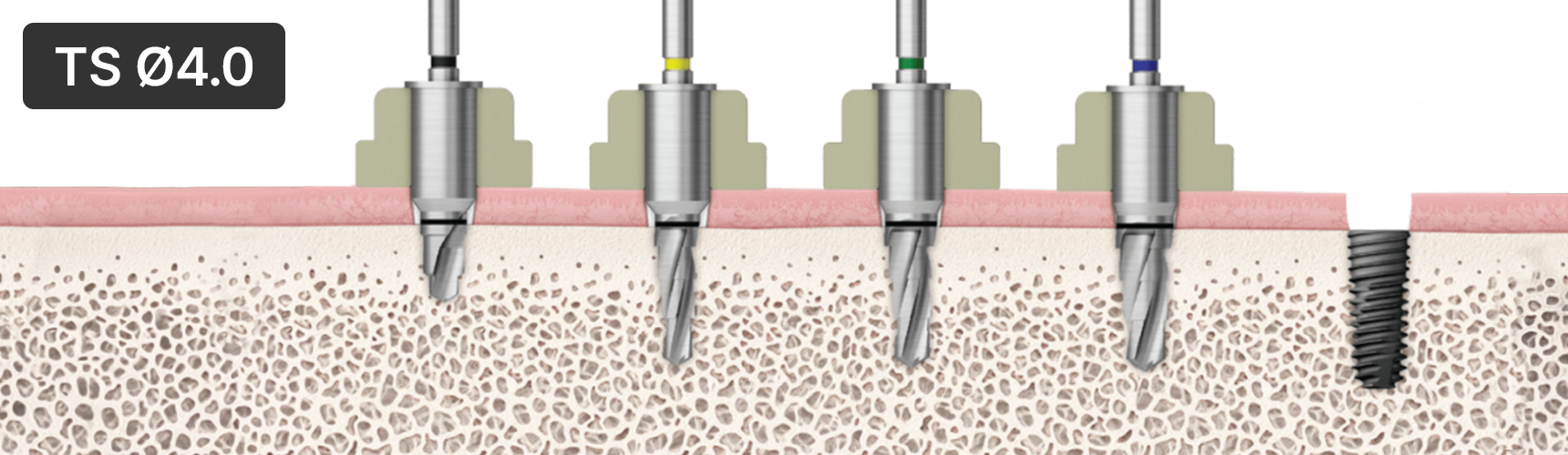 OneGuide simple and accurate drilling sequence