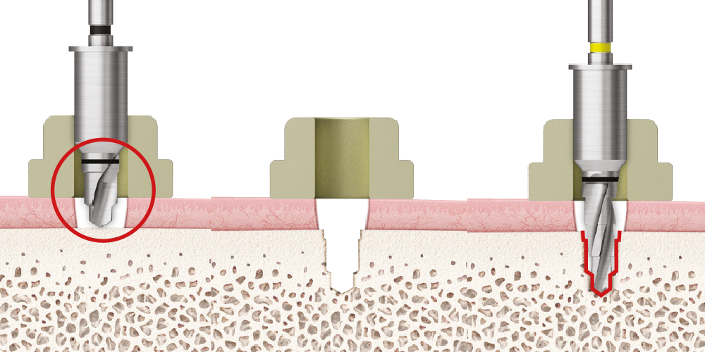 Precise surgery with stabilized drills