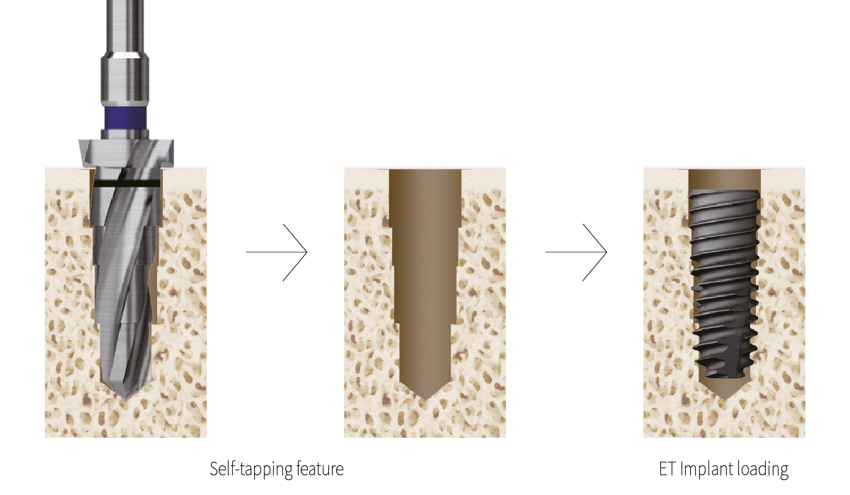 Safe and stable implantation in all bone types
