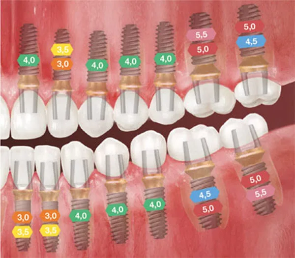 Recommended implant diameters