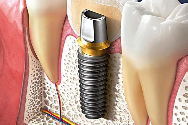 TS Implant