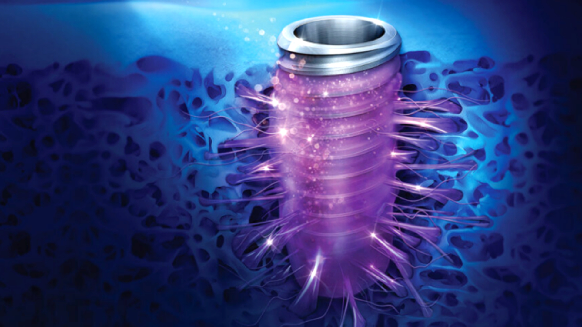TS SOI implant system combining SOI surface technology with a self-tapping dual-thread design