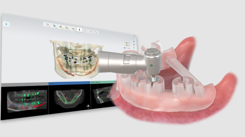 OneGuide guided surgery simulation screen